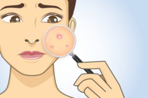 I suffered from acne, while my sister-in-laws all had perfect skin…until I discovered their secret